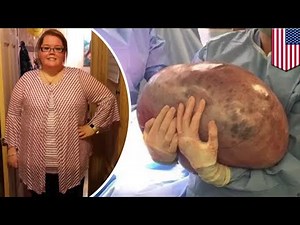 Giant 50 pound cyst removed from Alabama woman's ovary - TomoNews