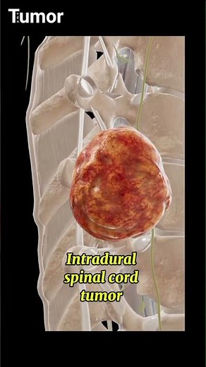 Intradural spinal cord tumor#pathology #3danimation #1millionviews#viralvideo