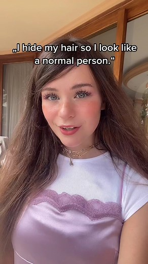 Understanding Piebaldism: Causes, Symptoms, and Treatment Options