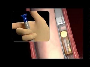 Posizionamento capsula pHmetria wireless BRAVO