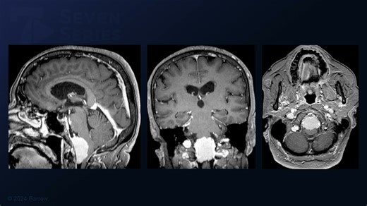 #359: Far Lateral Craniotomy for Resection of a Foramen Magnum Meningioma - All Videos - Seven Series Collection