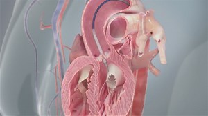 New procedure on life threatening heart disease helps patients live longer than ever before