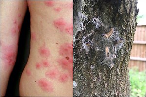 Poisonous caterpillars that cause vomiting and severe rashes invade Scotland