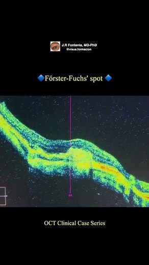 Förster-Fuchs' spot. High myopia.