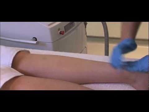 IPL Hair Removal - permanent hair reduction video