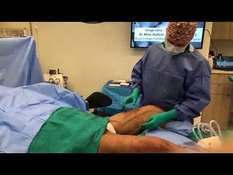 Dr. DuPéré LIVE Surgery: Full Vertical Inner-Thigh Lift