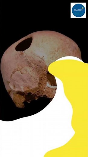 Trepanation - a medical treatment? or ritual to let the demons out ? #shorts