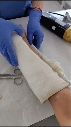 Remoción del yeso: ¿Cómo queda la mano después?