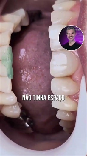 Vertical Dimension of Occlusion - VDO / Bruxism