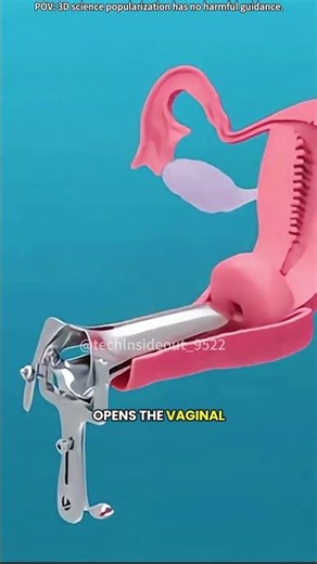 Intrauterine Device For Birth Control #doctor #3danimation #fingerinjury #adventure #anatomy