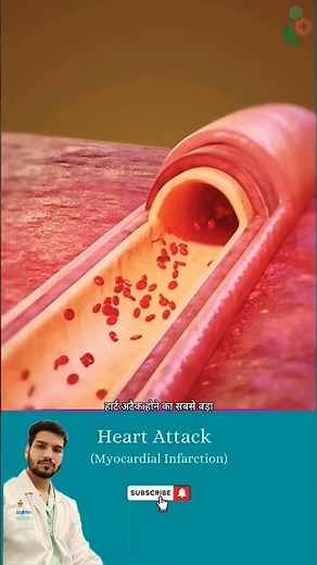 Heart attack (myocardial infarction)in 3d animation 👨‍⚕️⚕️