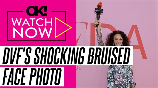 Diane von Furstenberg Reveals Shocking Photo of Her Bruised Face After Falling on Pavement and 'Hitting' Her Forehead in L.A.
