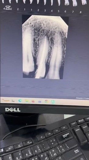 Root canal treatment.RCT #dentist #endodontic