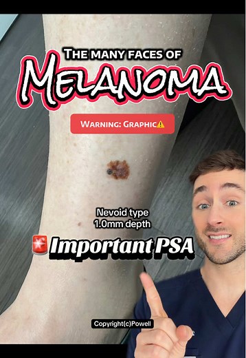 The many faces of melanoma. 🎭 👉From superficial spreading to nodular, lentigo maligna, and even invasive metastatic melanoma — there is no single “look.” ⚠️ Some melanomas start as tiny dots, but size does not always equal seriousness. Even small lesions can spread to lymph nodes and beyond. 😳 Know the faces. Catch it early. Lives depend on it. 🖤 #MelanomaMonday #MelanomaAwareness #Melanoma #SkinCancer #greenscreen