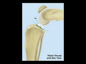 TPLO Movie Illustration