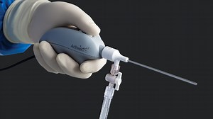 Best Portals to Treat OCD Lesions Using the NanoScope™ Operative Arthroscopy System