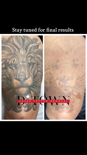 9 Sessions of Laser Tattoo Removal Results in Dallas