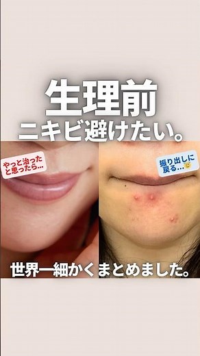 ニキビ改善に必須！生理前ニキビ克服スキンケア🔥 #ニキビケア #スキンケア #肌荒れ #インナーケア