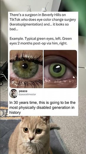 Before and after eye color change surgery