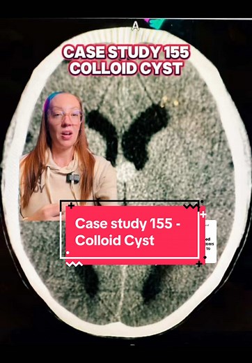 Understanding Colloid Cysts: A Case Study Overview
