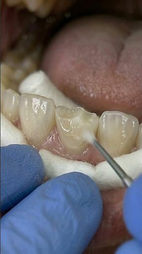 Composite Tooth Restoration | Front Tooth Aesthetic Repair