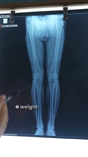 What Is a Scanogram? 🦴 | How It Helps Doctors Treat Patients Better #shorts #scan