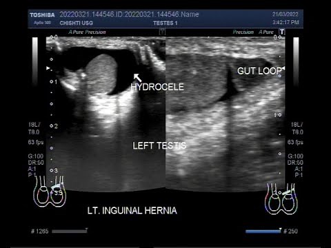 Inguinal Hernia in a child of 9 years, Ultrasound Findings.