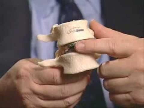 PRODISC® Lumbar Artificial Disc Replacement (ADR) Surgery - The Spine Institute Santa Monica CA