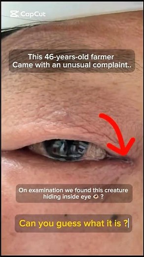 PART 1: Live Maggot removed from Human Eye/Ophthalmomyiasis #shorts