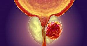 Exploring New Insights Into Prostate Cancer Treatment and Screening - News Center