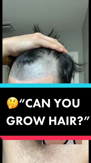 Can Hair Grow on Tattoos? Understanding Hairline Tattoos and Baldness