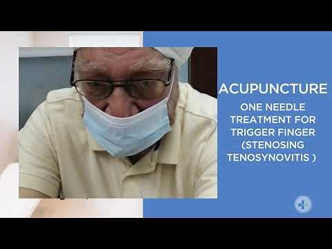 Acupuncture : One Needle Treatment For Trigger Finger