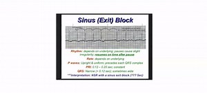 Sinoatrial Exit Block | Cardiology-Dr.AsifUllah | Facebook