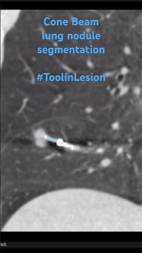 Lung nodule cone beam segmentation