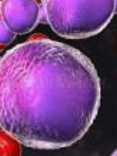 Leukemia Leukemia is a type of blood cancer that starts in the bone marrow — the place where blood cells are made. It causes the body to produce abnormal white blood cells that don’t fight infection properly. ⚠️ Common signs include fatigue, frequent infections, easy bruising, bleeding, fever, and unexplained weight loss. Early detection can save lives. Awareness matters. Knowledge is power. 💪 #Leukemia #BloodCancer #HealthAwareness #MedicalEducation #StayInformed #Healthcare #BoneMarrow #Cance