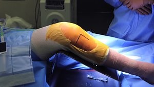 Repair of Tibial Plateau Fracture Schatzker II