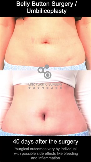 Belly Button Surgery Great Results | #plasticsurgery #plasticsurgeon #plasticsurgerykorea #koreaplasticsurgery #umbilicoplasty #bellybutton #bellybuttonsurgery #navel #navelsurgery #korea #korean #seoul #southkorea #beauty #kbeauty #pretty #f #fyp #foryou #fypシ #foryoupage #fy #foryourpage