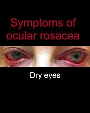 Ocular Rosacea