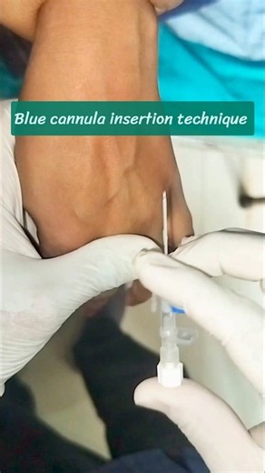 Cannula Insertion Technique 💉 | Perfect Method for Beginners | IV Cannulation #shorts #ivcannulation
