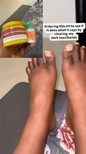 Dark Toes? This Cleared in 3 Weeks #hyperpigmentation #darkspots #beauty #footcare #feet #football