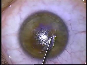 Cirugía Refractiva láser Relex Smile