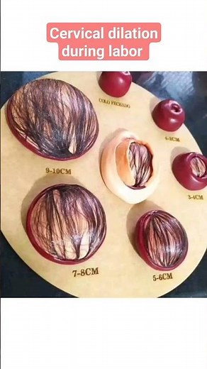 Cervical dilation during labor