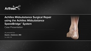 Achilles Midsubstance Surgical Repair using the Achilles Midsubstance SpeedBridge™ System