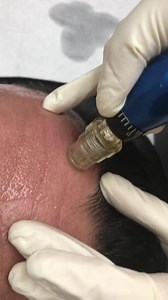 Microneedling with InnoPen to Reduce Wrinkles
