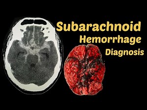 Acute Subarachnoid Hemorrhage | CT Scan | Radiology | Diagnosis