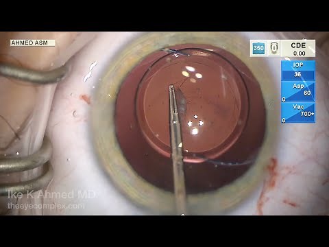 Congenital Posterior Polar Cataract: Detailed Surgical Technique