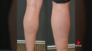 399K views · 1.1K reactions | An increasing number of young men are feeling the need to get calf implants, with an invasive but popular surgery. Report in 7NEWS at 6pm. www.7NEWS.com.au #CalfImplants #7NEWS | 7NEWS Adelaide | Facebook