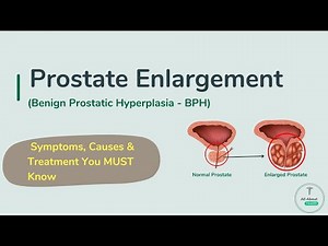 Prostate Enlargement: Symptoms, Causes & Treatment You MUST Know | BPH Warning Signs