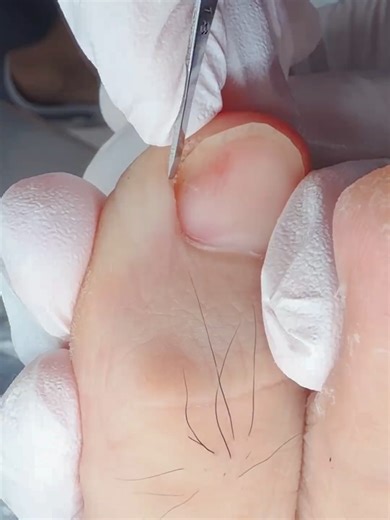 🦶 tiny edge big relief unlocked 🦶 #trending #viral #podiatry #relief