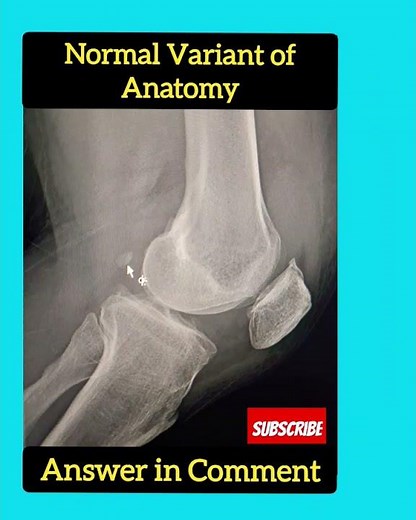 ? Normal Variant Anatomy -X- Ray Knee - Radiology